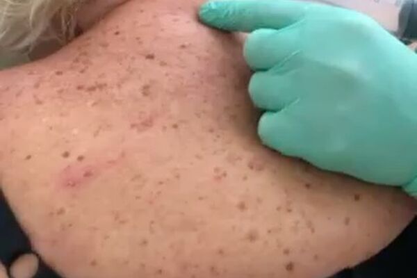 МЕСТНАЯ ОЗОНОТЕРАПИЯ - не больно, нежно, результативно ️Легкая рука у Мизонова Сергея Владимировича