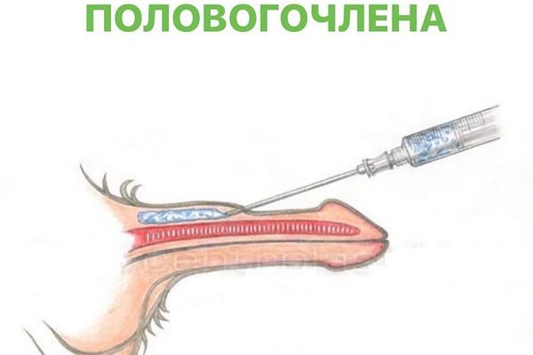УВЕЛИЧЕНИЕ ПОЛОВОГО ЧЛЕНА гиалуроновой кислотой (интимный филлинг, аугментация члена) &ndash; малотравматичный, безопасный, быстрый и эффективный метод коррекции