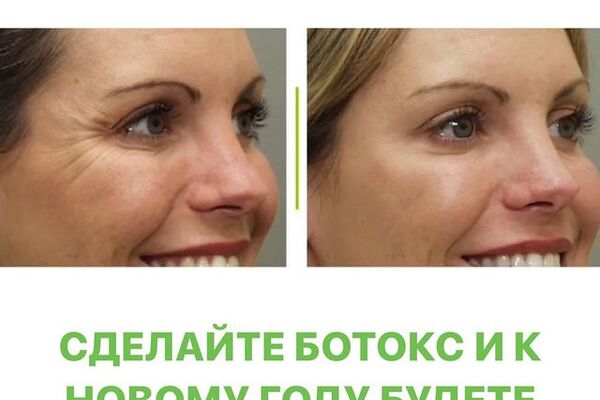 КАК БЫСТРО ИЗБАВИТЬСЯ ОТ МИМИЧЕСКИХ МОРЩИН?