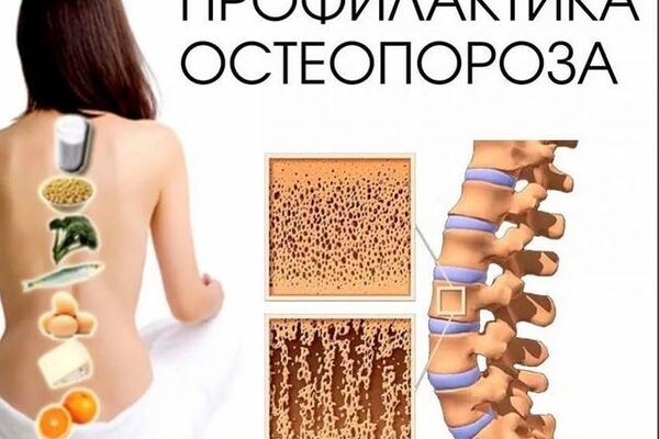 Остеопороз &ndash; это заболевание