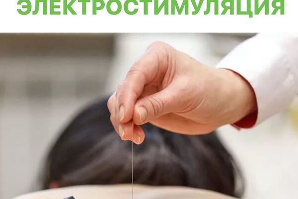 ВНУТРИТКАНЕВАЯ ЭЛЕКТРОСТИМУЛЯЦИЯ проводится игольчатым электродом
