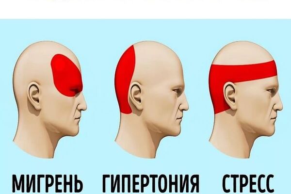 Головная боль напряжения&nbsp;&mdash; средняя или сильная боль во всей голове или в отдельной ее части