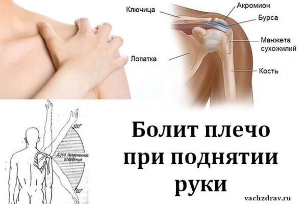 БОЛИТ ПЛЕЧО ПРИ ПОДНЯТИИ РУКИ?