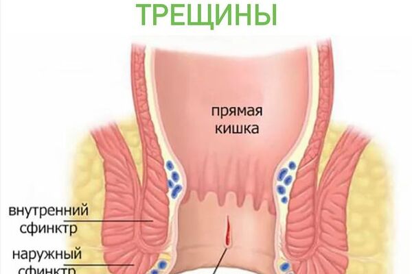 Анальная трещина.