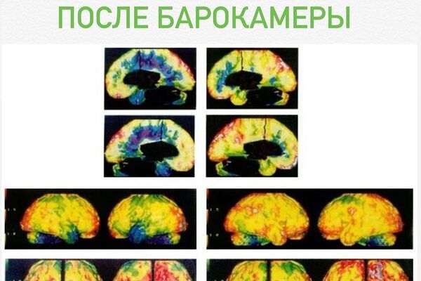 КАК БАРОКАМЕРА ВЛИЯЕТ НА КРОВОСНАБЖЕНИЕ ГОЛОВНОГО МОЗГА.