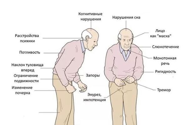 Паркинсонизм.