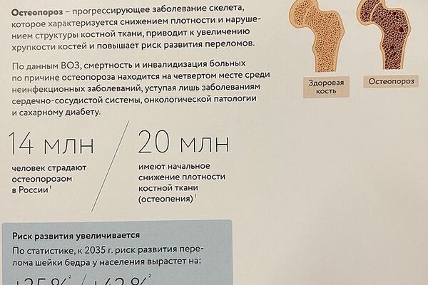 ОСТЕОПОРОЗ - снижение минеральной плотности костной ткани.