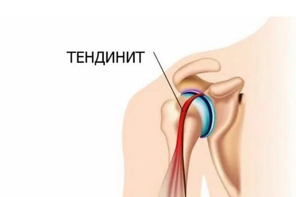 Боль в плече. что делать?