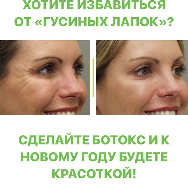 КАК БЫСТРО ИЗБАВИТЬСЯ ОТ МИМИЧЕСКИХ МОРЩИН?