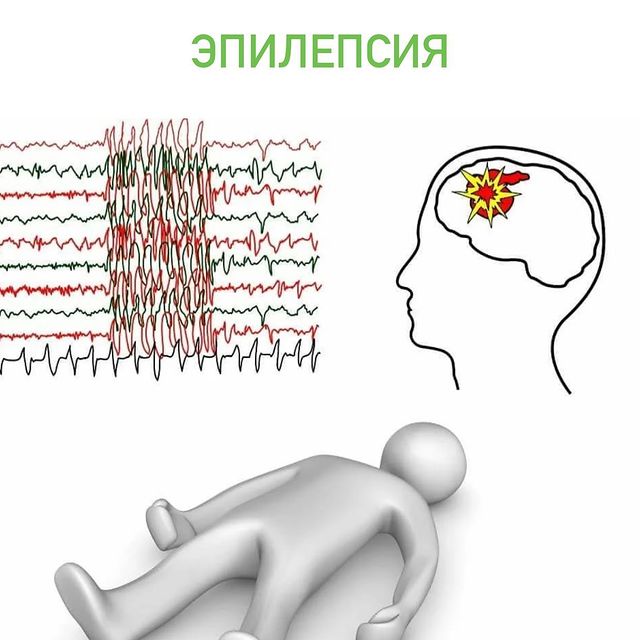 ЭПИЛЕПСИЯ.