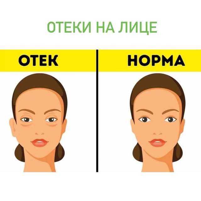 ОТЕКИ НА ЛИЦЕ ?